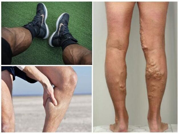 كيف تبدو الدوالي على أرجل الرجال