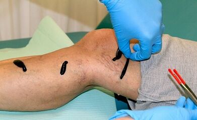 العلاج hirudother