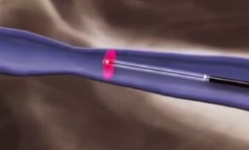 العلاجات الحرارية